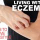 Living with Eczema:10 Tips For Improving Your Lifestyle 5