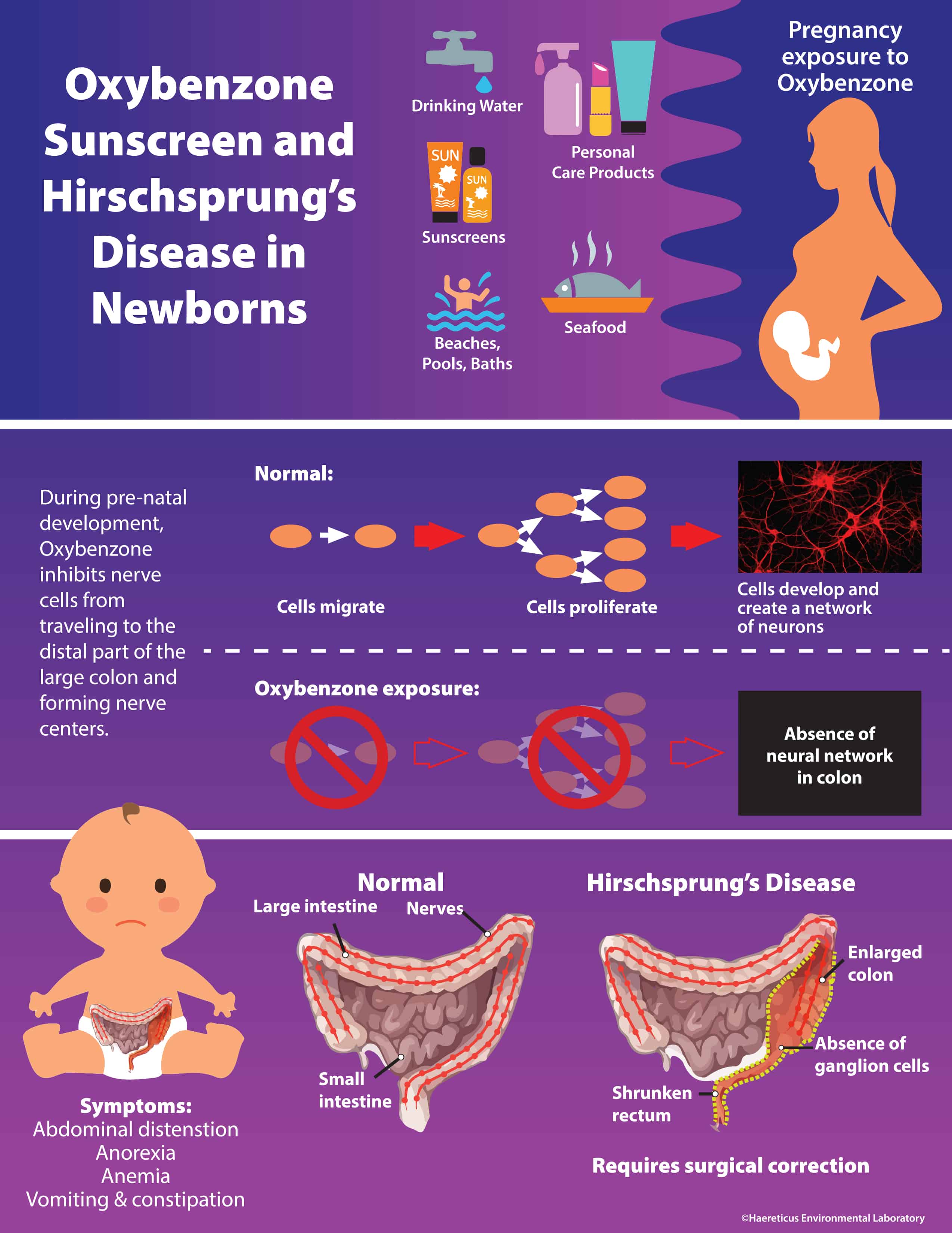 oxybenzone chemical sunscreens linked to hirschsprung's disease