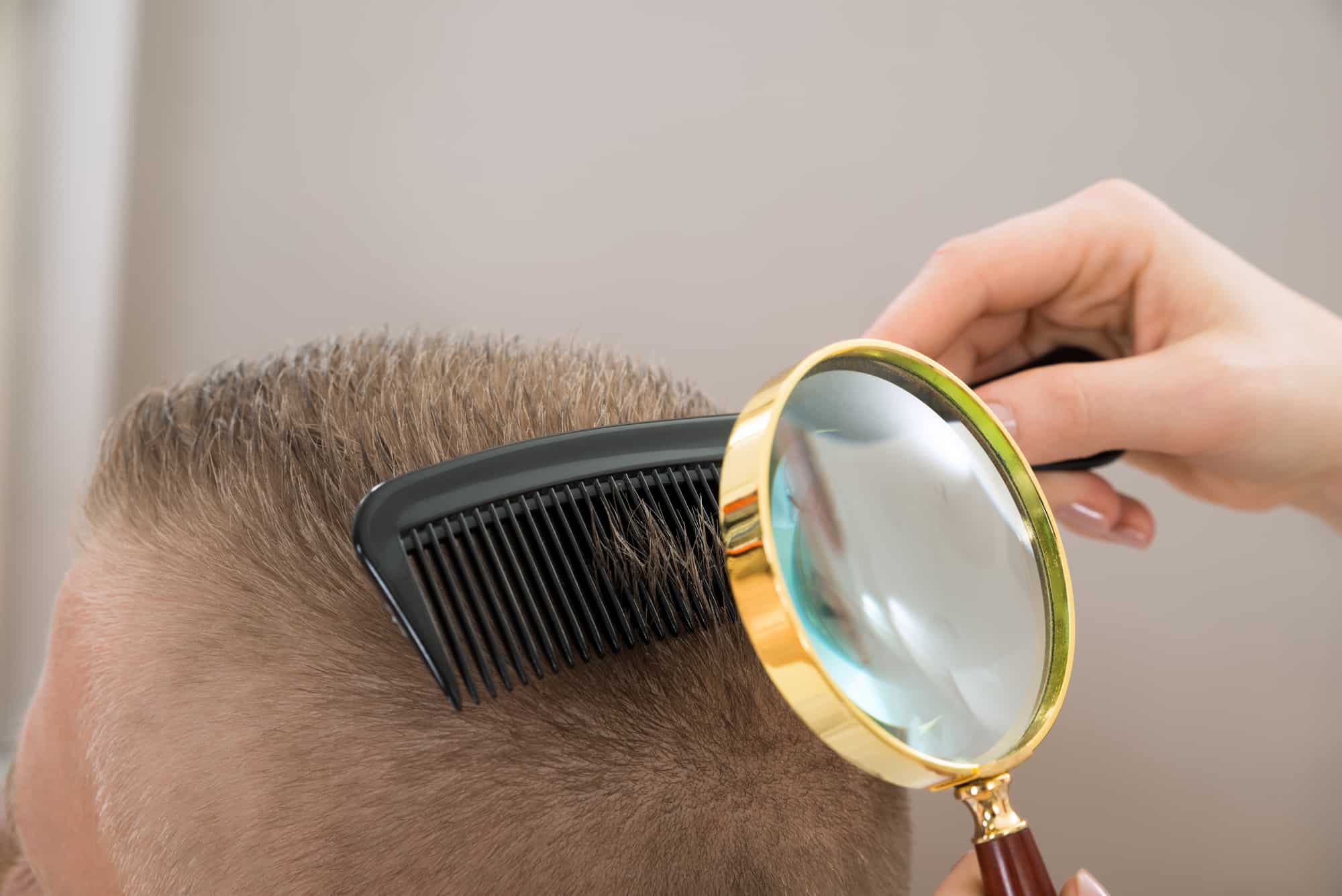 Close-up Dermatologist Looking At Patient's Hair Through Magnifying Glass