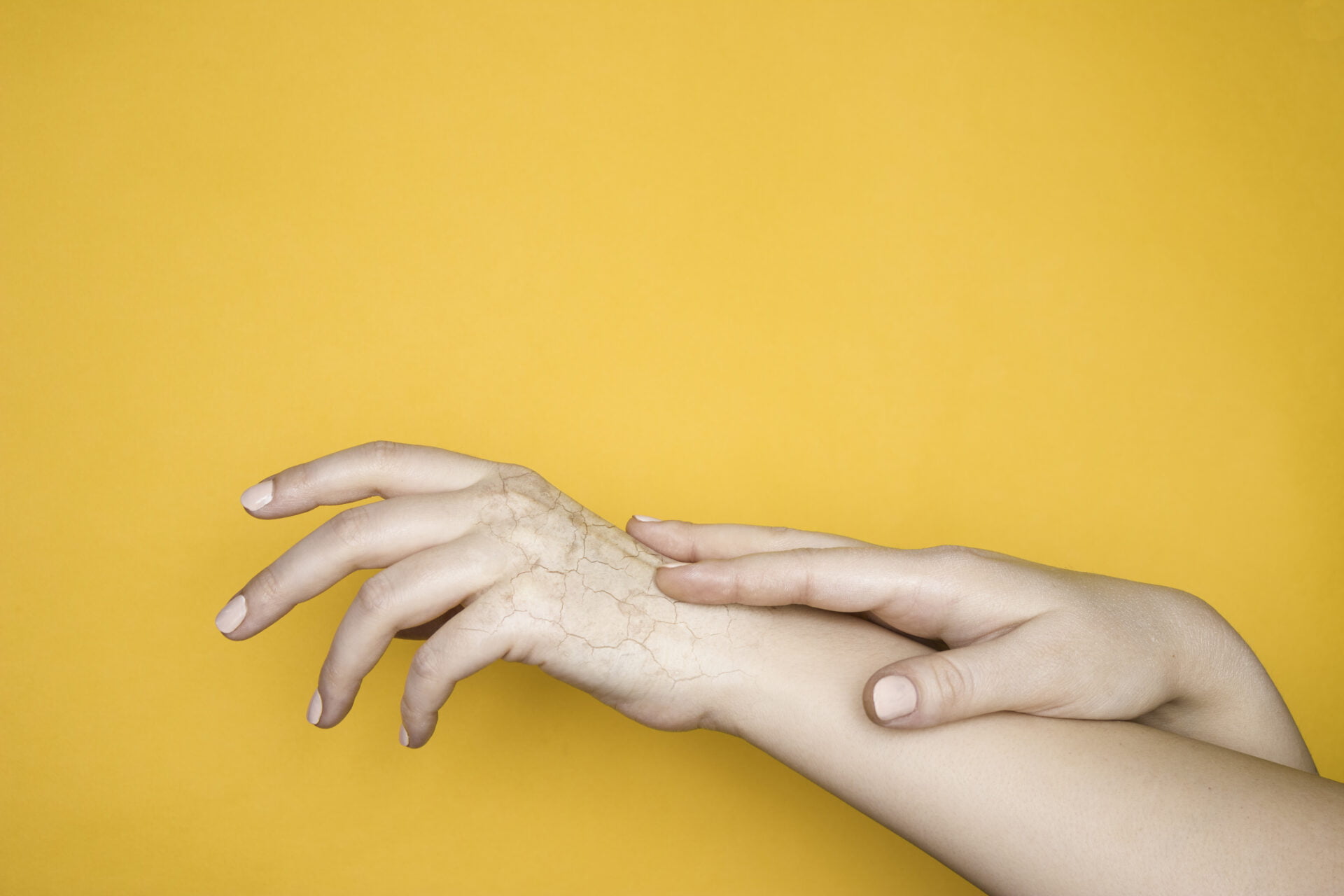 Hands with dry cracked skin, the concept of hand skin problems