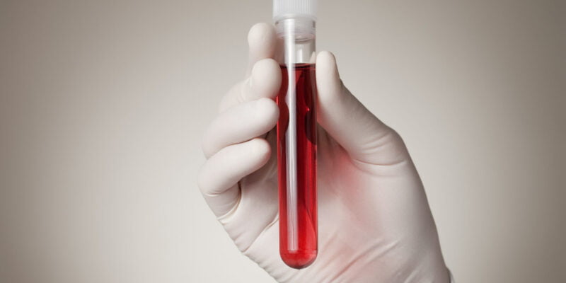 Lab technician holding blood ready to test for PFAS